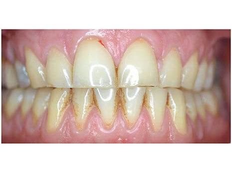 chistka-ot-zubnogo-kamnya-do chistka-ot-zubnogo-kamnya-do