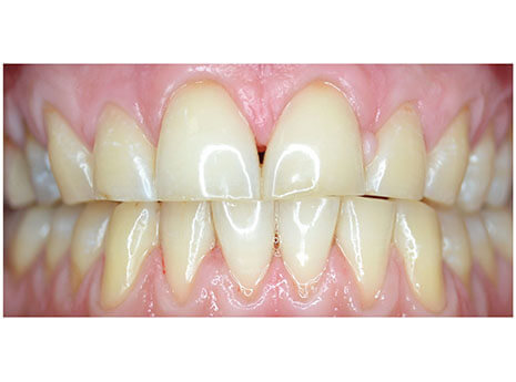 Чистка от зубного камня Чистка от зубного камня