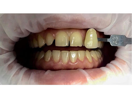 otbelivanie-zubov-do otbelivanie-zubov-do