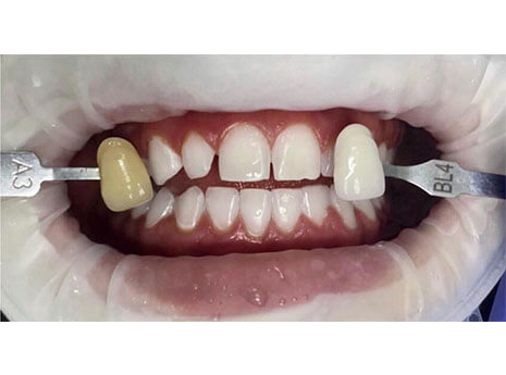 Отбеливание зубов Отбеливание зубов